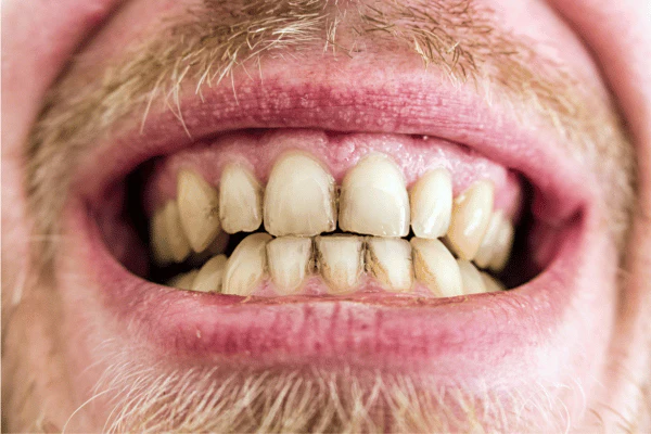 Does Laser Teeth Whitening Work on Coffee, Tea, or Smoking Stains Seaford