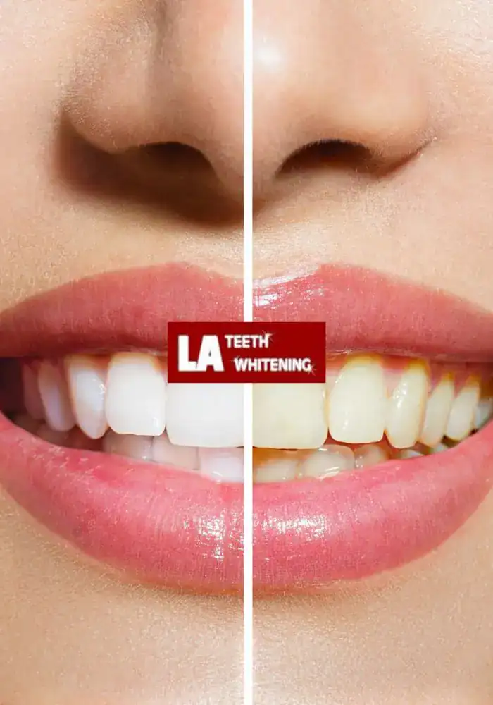 How Safe Is Laser Teeth Whitening for Teenagers and Adults Seaford