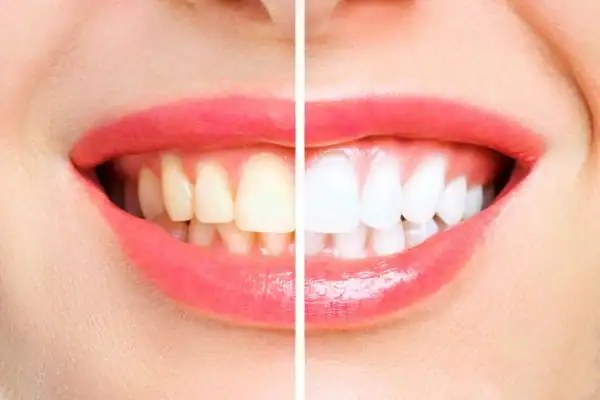 What Are the Common Myths About Laser Teeth Whitening Seaford